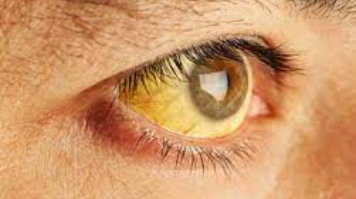 Jaundice Home Remedies: पीलिया को जड़ से ठीक करने के लिए अपनाएं ये घरेलू नुस्खे