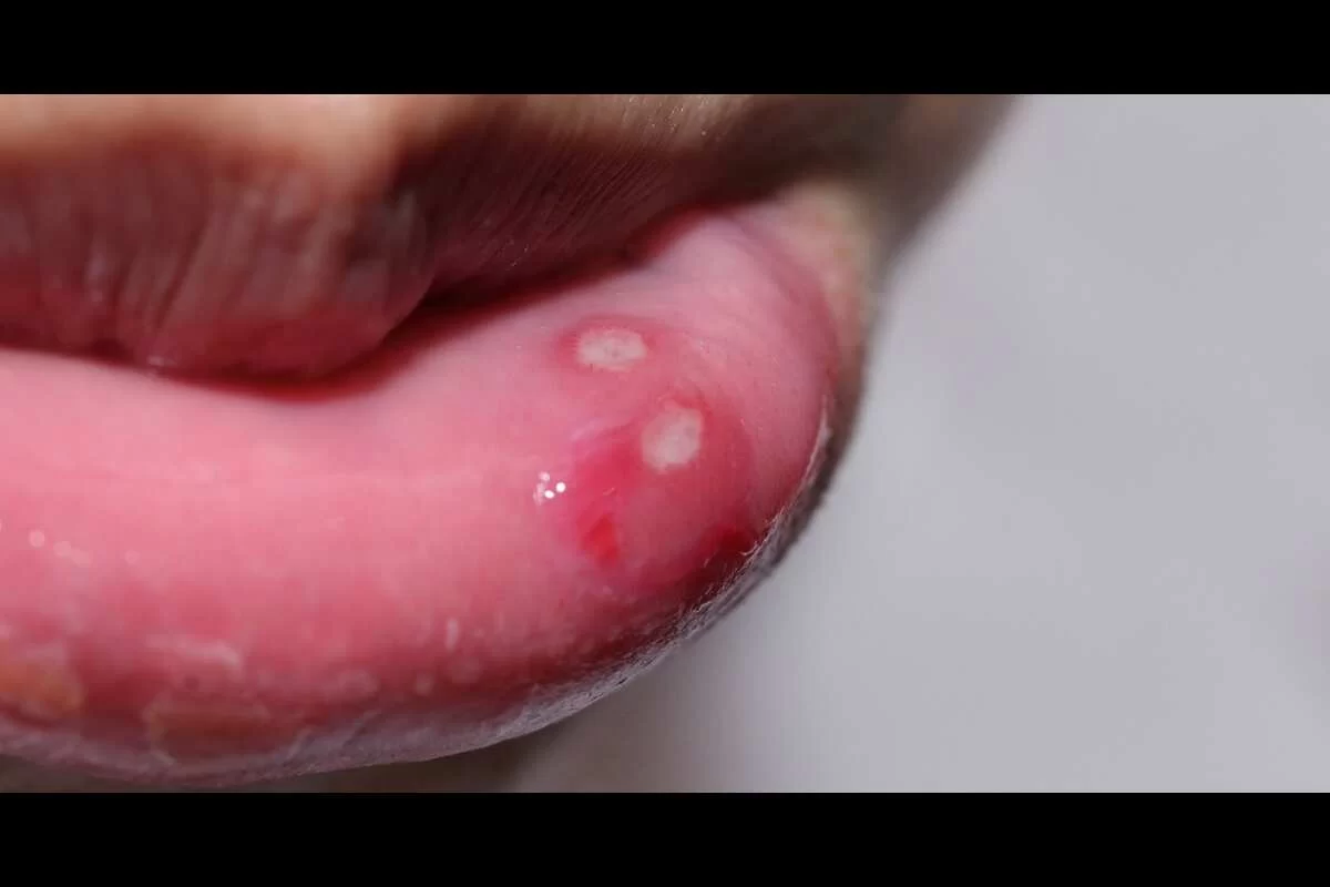 Home remedies for Mouth Ulcers